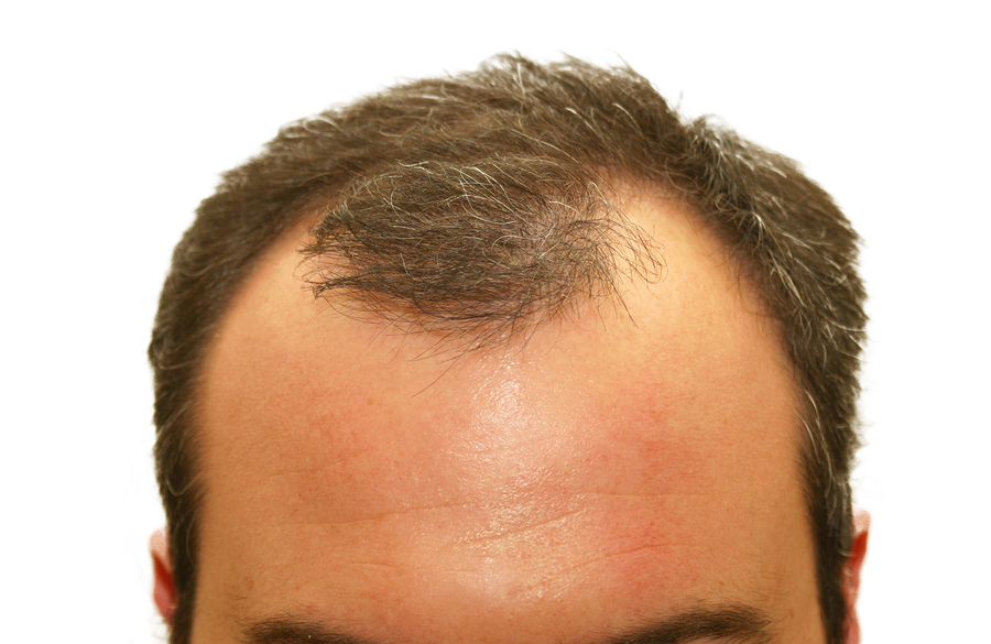 how to regrow hair from balding